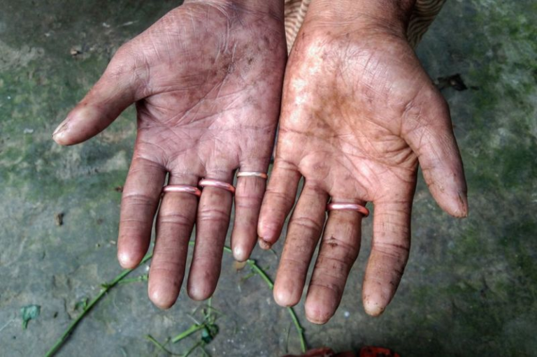 Strange: The family that has no fingerprints on the palms(images)